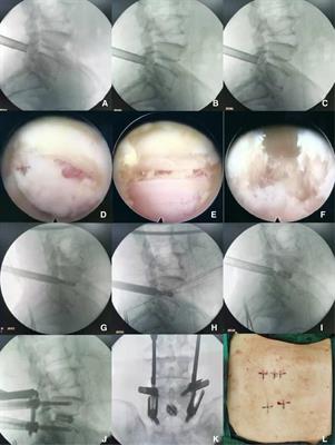 Comparison of short-term efficacy of MIS-TLIF and Endo-LIF in the treatment of single-segment degenerative lumbar diseases